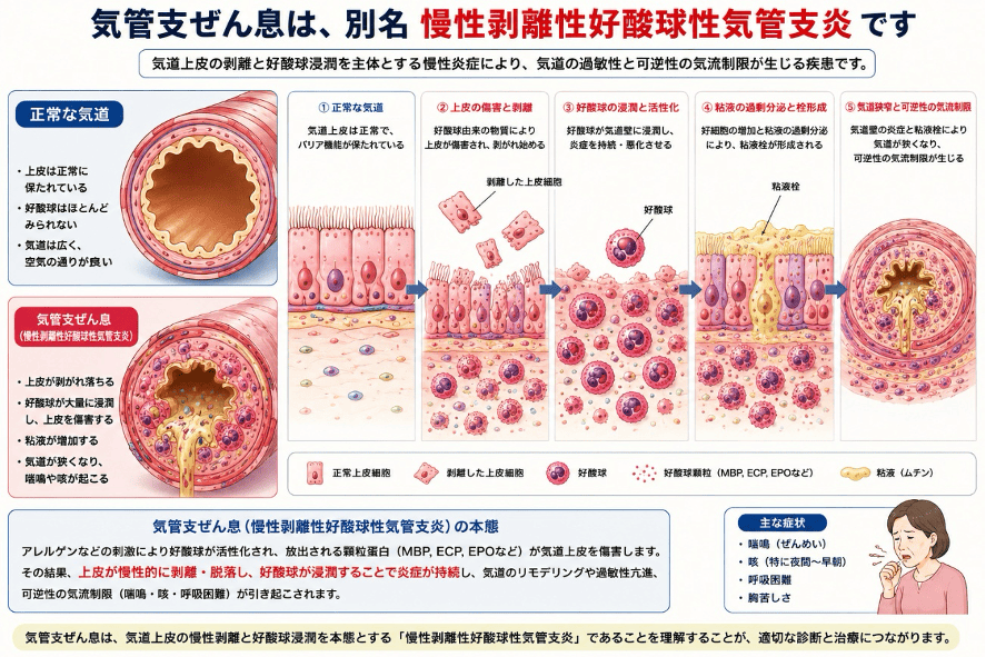 気管支ぜん息は別名慢性剥離性好酸球性気管支炎です